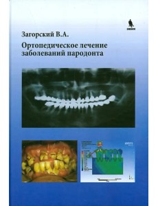 Ортопедическое лечение заболеваний пародонта