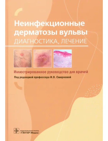 Неинфекционные дерматозы вульвы. Диагностика, лечение. Иллюстрированное руководство