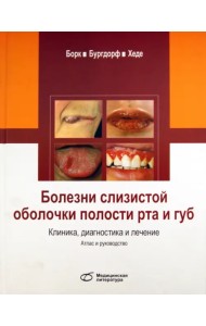 Болезни слизистой оболочки полости рта и губ. Клиника, диагностика и лечение
