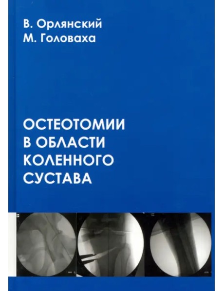 Остеотомии в области коленного сустава