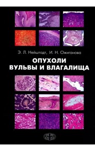 Опухоли вульвы и влагалища