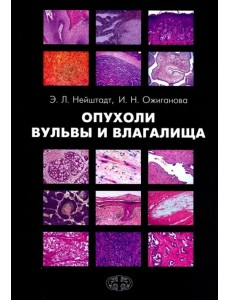 Опухоли вульвы и влагалища