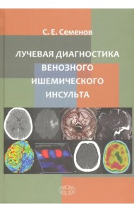 Лучевая диагностика венозного ишемического инсульта