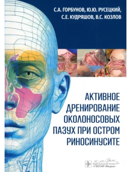Активное дренирование околоносовых пазух при остром риносинусите
