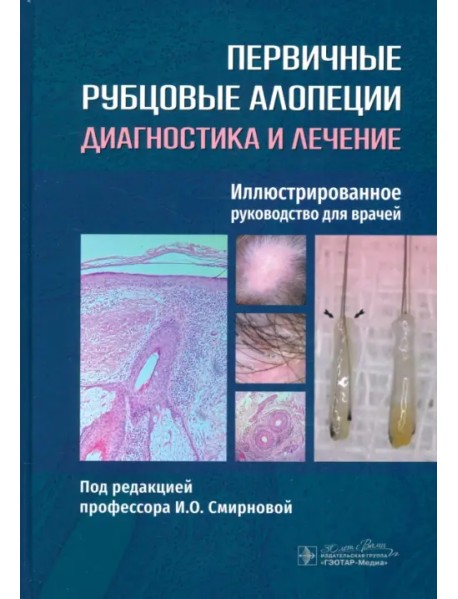 Первичные рубцовые алопеции. Диагностика и лечение. Иллюстрированное руководство для врачей