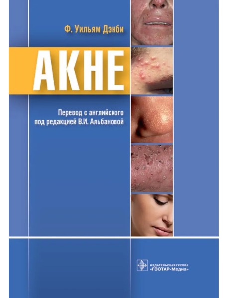 Акне