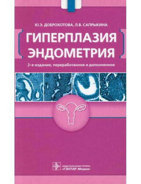 Гиперплазия эндометрия