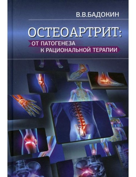 Остеоартрит: от патогенеза к рациональной терапии