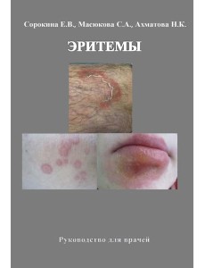 Эритемы. Руководство для врачей