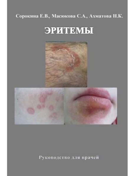 Эритемы. Руководство для врачей