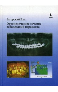 Ортопедическое лечение заболеваний пародонта
