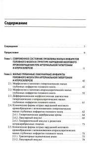 Малые инфаркты головного мозга