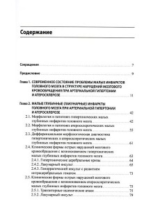 Малые инфаркты головного мозга