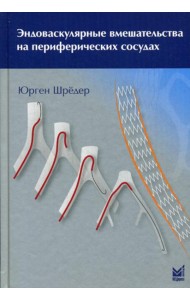 Эндоваскулярные вмешательства на периферических сосудах
