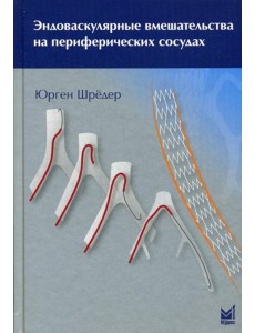 Эндоваскулярные вмешательства на периферических сосудах