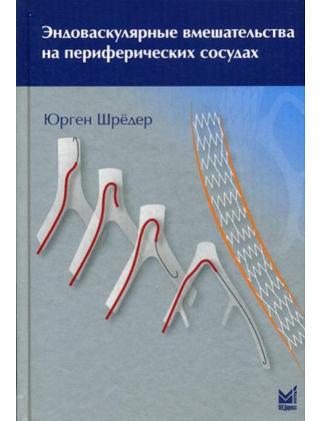 Эндоваскулярные вмешательства на периферических сосудах