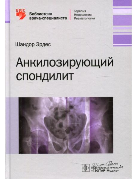 Анкилозирующий спондилит