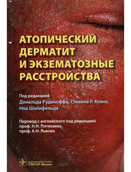 Атопический дерматит и экзематозные расстройства