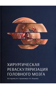 Хирургическая реваскуляризация головного мозга