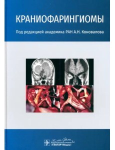 Краниофарингиомы