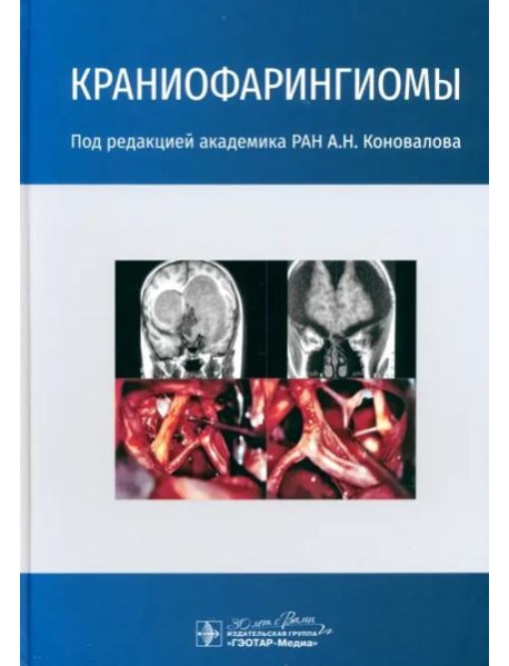 Краниофарингиомы