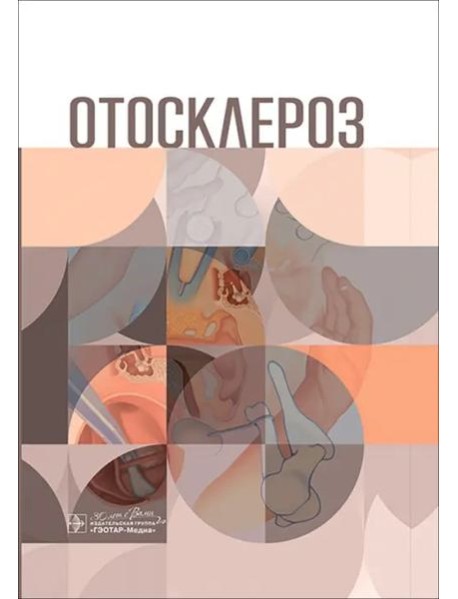 Отосклероз