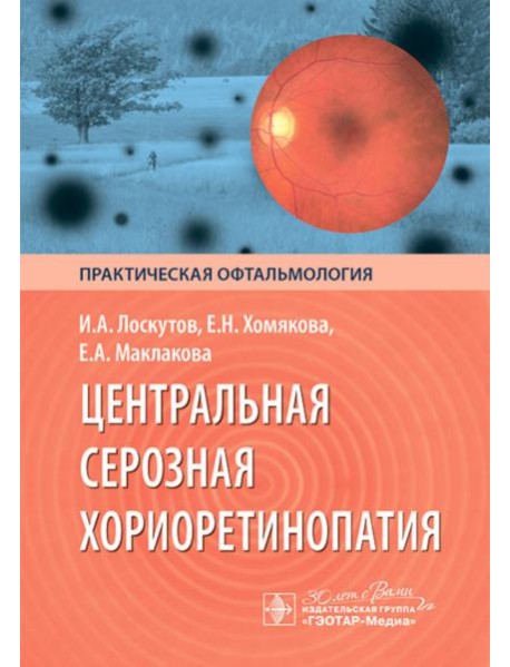 Центральная серозная хориоретинопатия