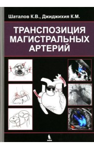 Транспозиция магистральных артерий