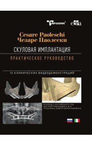 Скуловая имплантация. Практическое руководство - Чезаре Паолески
